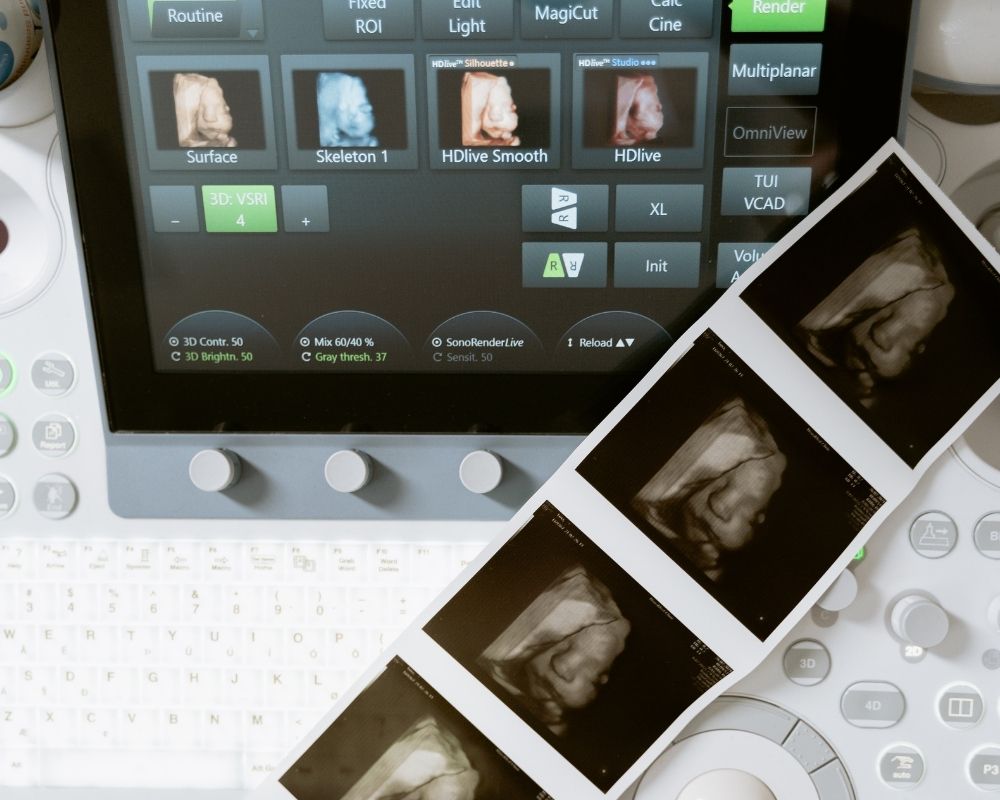 Ecrã de uma máquina de ecografia (ultrassom) com várias opções de imagens 3D de um feto, e uma tira de fotos de ecografia com imagens do bebé impressas.